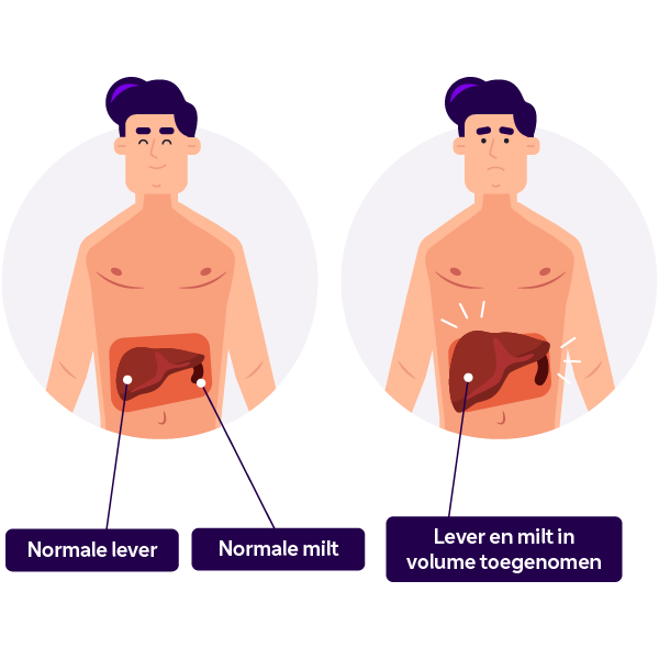 Vergrote lever en milt
