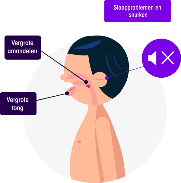 Man die door verdrukking van vergrote amandelen en een vergrote tong slaapproblemen heeft.