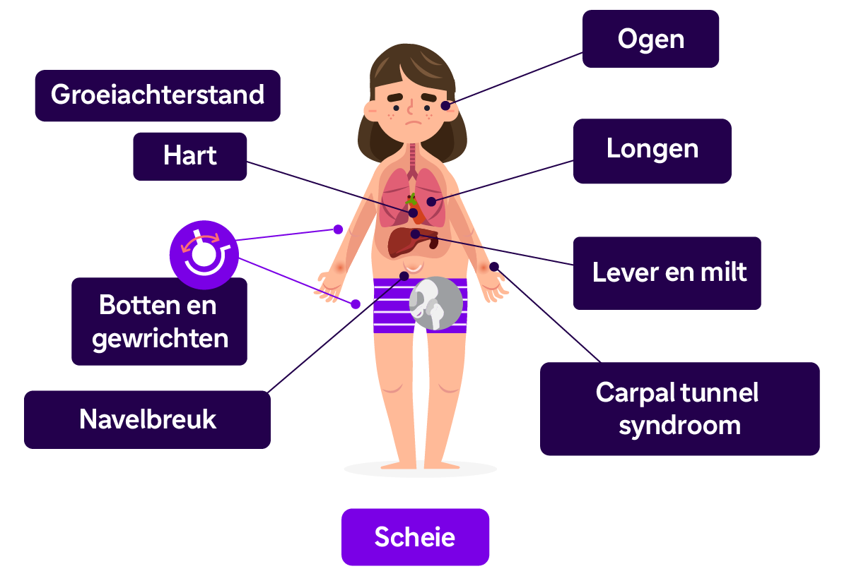 Vrouw met typische symptomen van de Scheie vorm van MPS I.