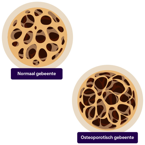 Normaal gebeente vs. Osteoporotisch gebeente