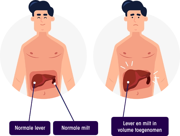 Man met normale lever en milt vs. een man met een vergrote lever en milt.