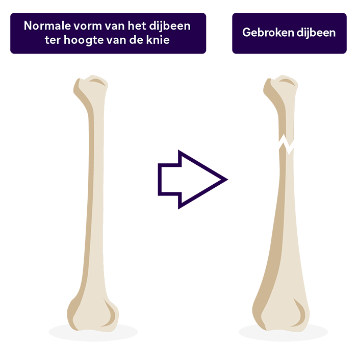 Normaal dijbeen vs. gebroken dijbeen