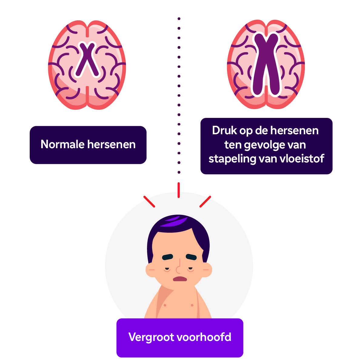 Man met vergroot voorhoofd.